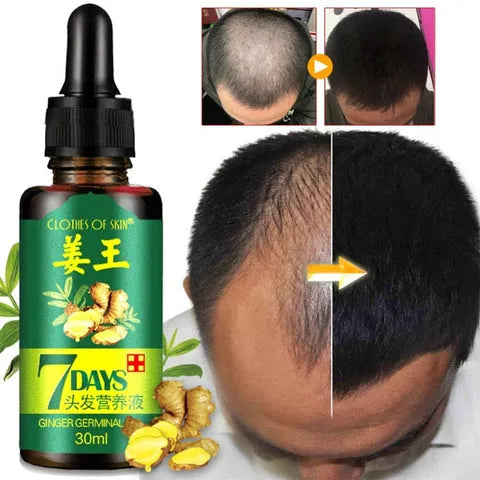 Imported Derma Roller Deep Penetrative & GINGER GERMINAL OIL for fast hair growth